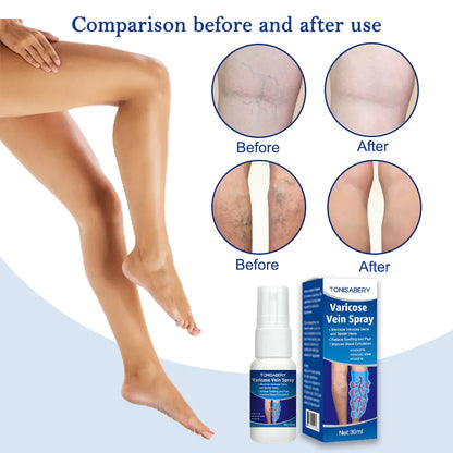 30ml Varicose Vein Massage Spray for Leg Relief